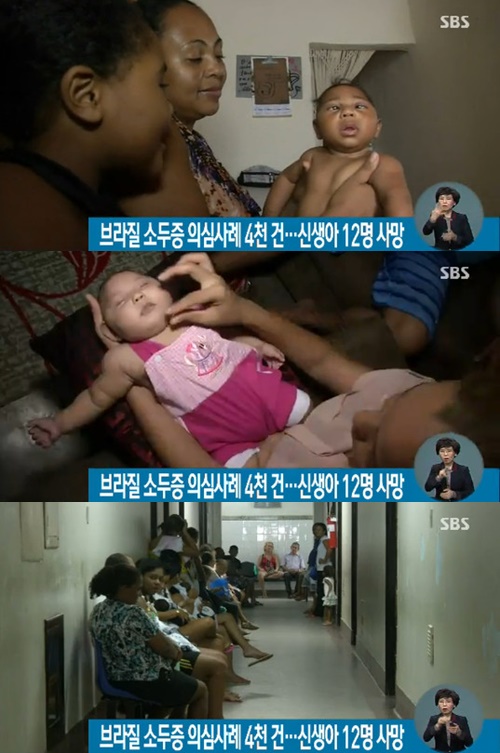 사진:브라질소두증의심