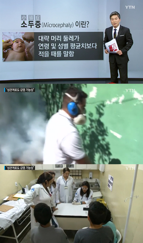 사진 : YTN 뉴스 /  소두증 지카바이러스
