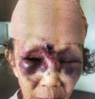 묻지마폭행 용의자 체포, 피해 할머니 (사진=주 LA 총영사관 트위터)